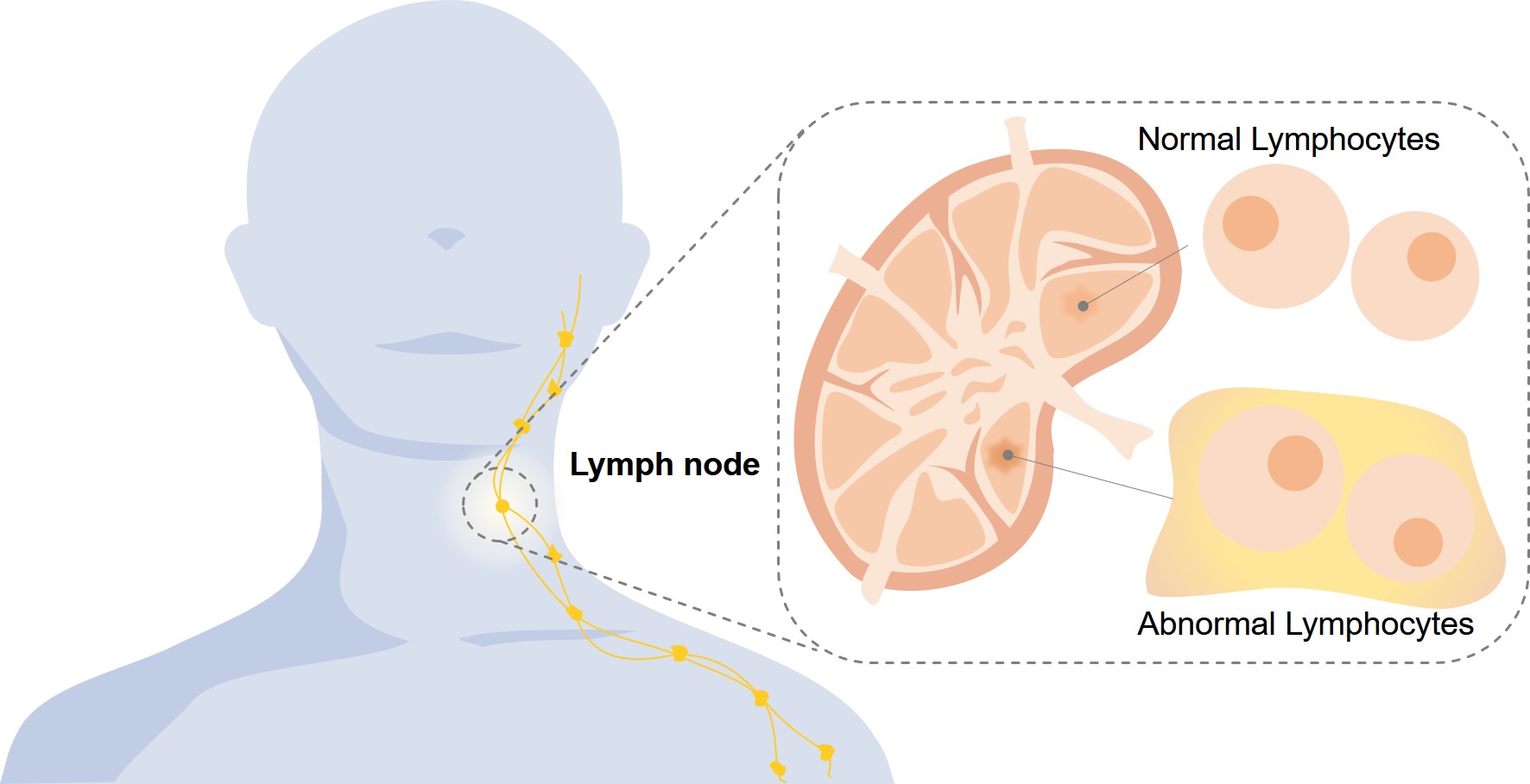 Schematic of lymphoma. (Creative Biolabs Original)